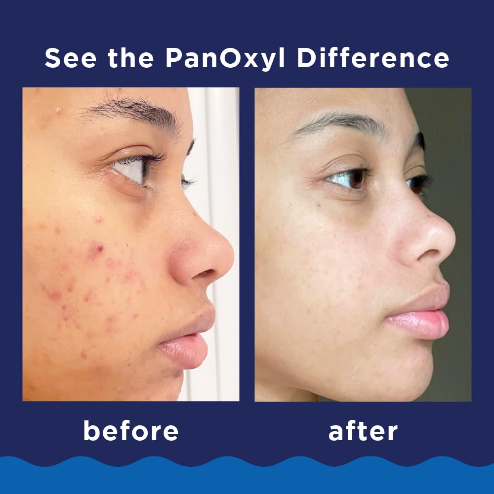 PanOxyl 10% Benzoyl Peroxide Acne Foaming Wash – Maximum Strength Face & Body Cleanser
